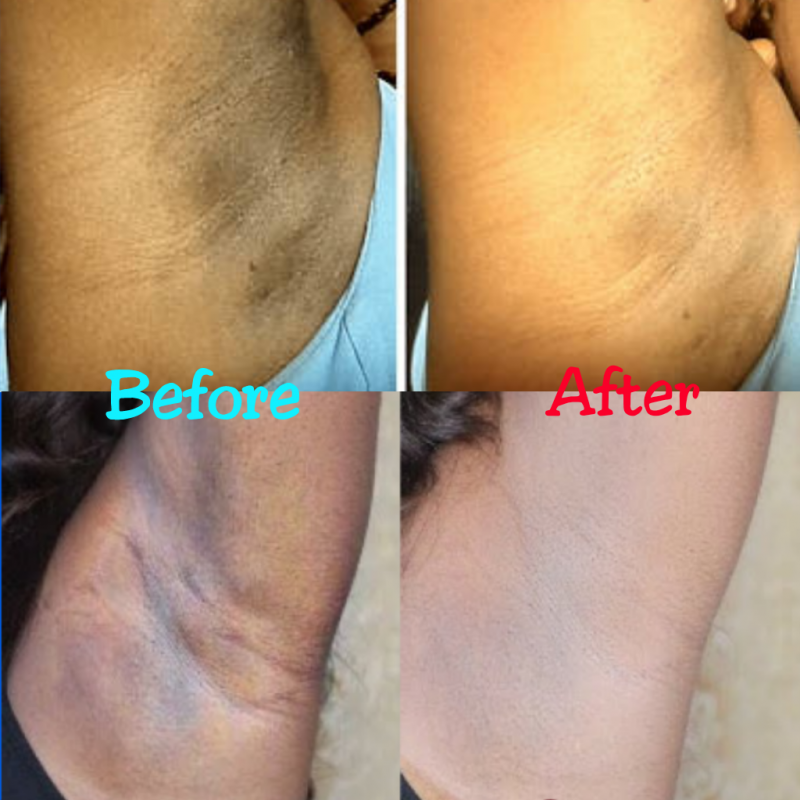 Get Rid of Dark Armpits | Treatment, Causes, HomeCures - SwitSmell