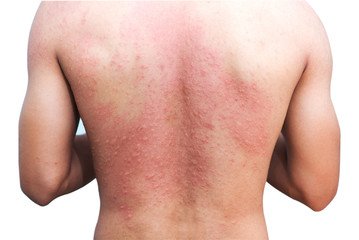 Sweat Rash on Back 