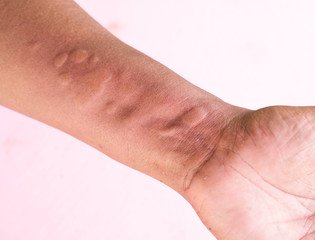 Sweat rash on hand 