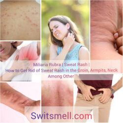 Miliaria Rubra | Sweat Rash | Treatment, Causes and Prevention - SwitSmell