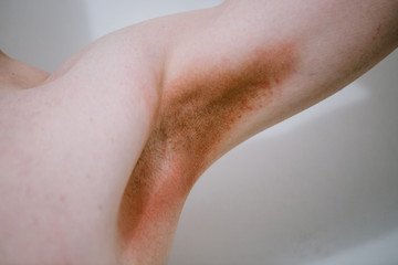 armpit rash pictures